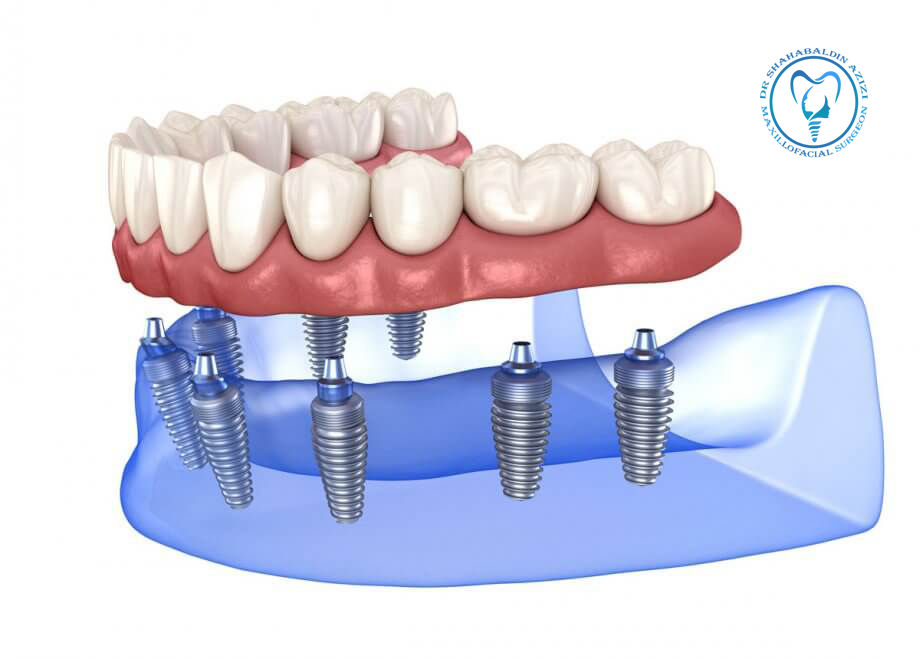 تعداد ایمپلنت در فک بالا و پایین