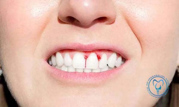 خون ریزی بعد از ایمپلنت دندان