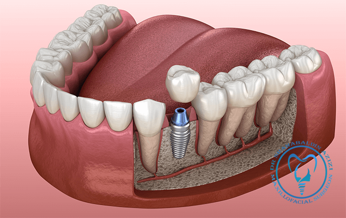 ایمپلنت و پوکی استخوان