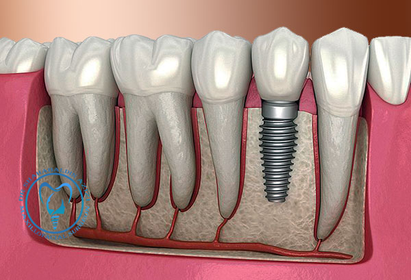 ایمپلنت و پوکی استخوان
