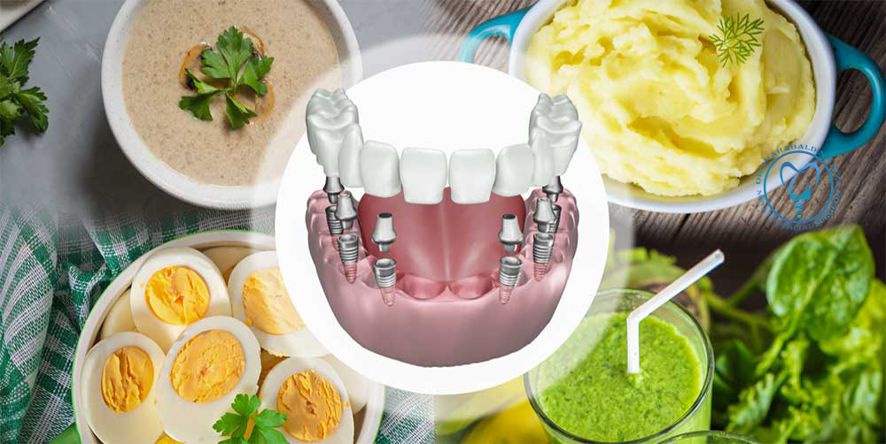 رژیم غذایی بعد از ایمپلنت دندان