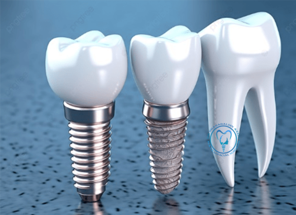 oneday ایمپلنت دندان در یک روز