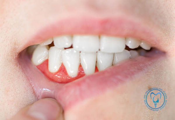 Abse آبسه لثه بعد از ایمپلنت
