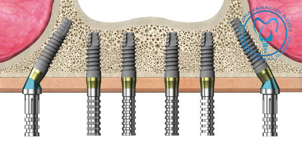 ایمپلنت دندان زاویه دار