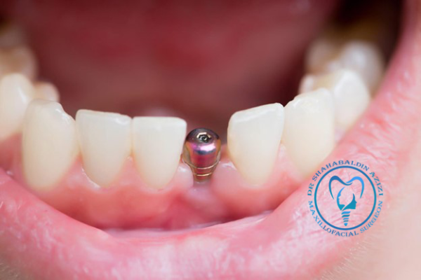 ایمپلنت دندان نیش ایمپلنت دندان نیش