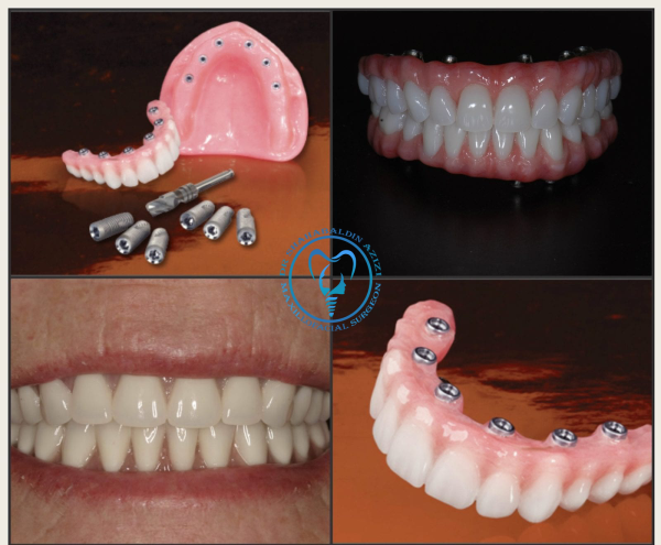 time2 چه مدت بعد از کشیدن دندان میتوان ایمپلنت کرد؟