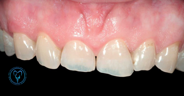 سایش ایمپلنت دندان سایش ایمپلنت دندان