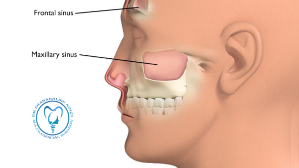 سینوس فک بالا سینوس فک بالا