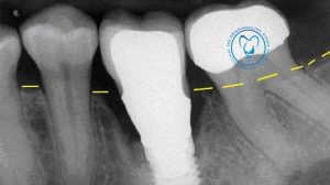 شل شدن ایمپلنت دندان