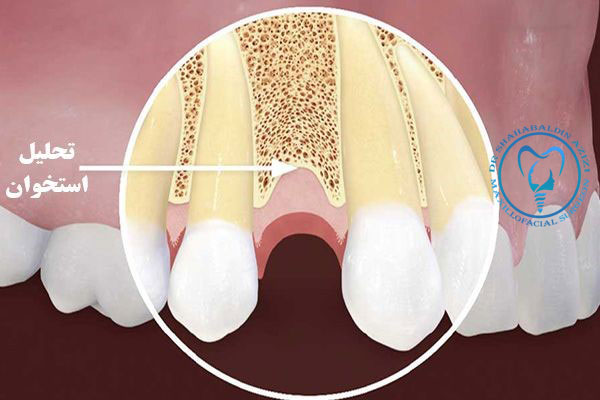 تحلیل استخوان فک بعد از ایمپلنت دندان