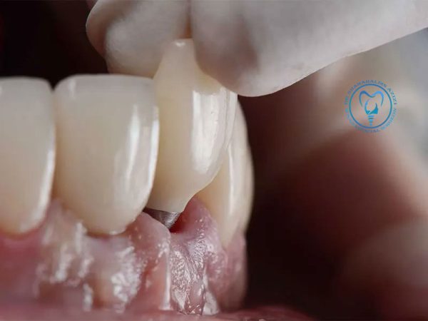 ترمیم ایمپلنت دندان