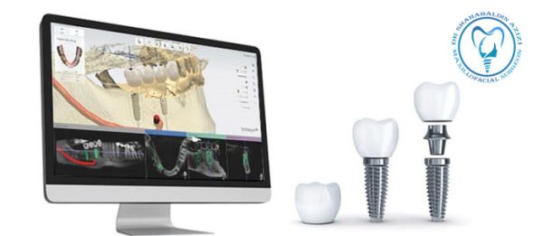 ایمپلنت دیجیتال