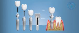 انواع ایمپلنت دندان ایرانی