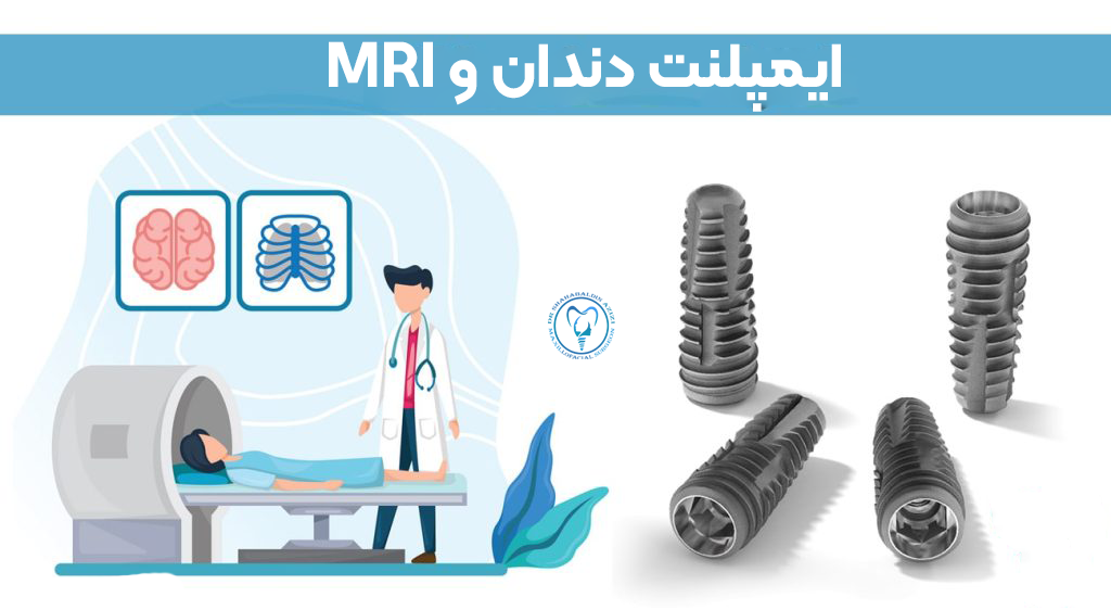 آیا ایمپلنت دندان با MRI تداخل داره؟