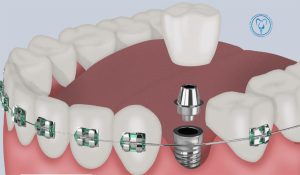 ایمپلنت و ارتودنسی همزمان