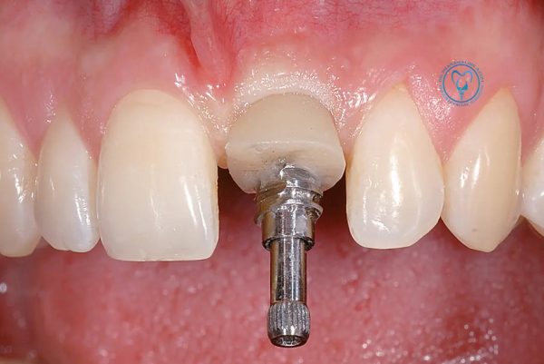 ایمپلنت دندان به روش فوری