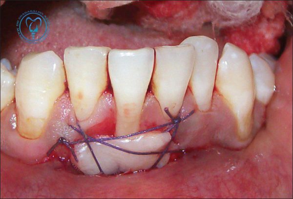 پیوند لثه قبل از انجام ایمپلنت دندان