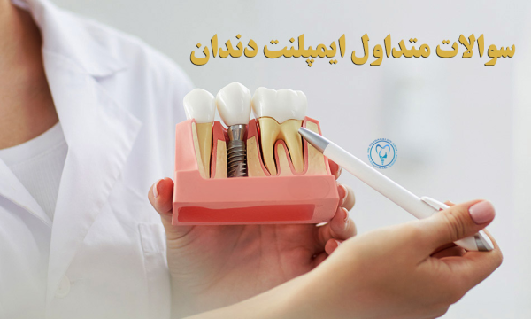 سوالات متداول درباره ایمپلنت دندان