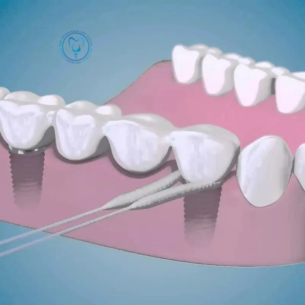 استفاده از نخ دندان برای دندان ایمپلنت شده