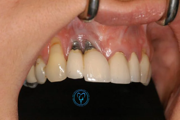 جلوگیری از خراب شدن ایمپلنت