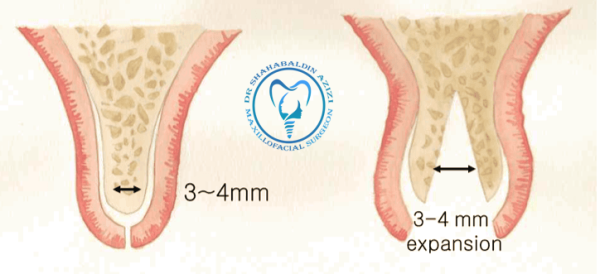 ریج اسپلیت چیست