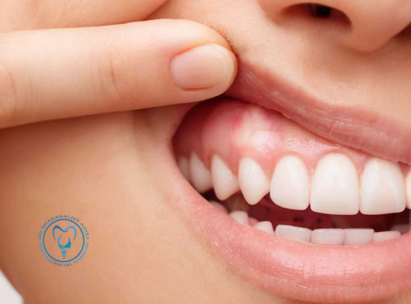 علت سفید شدن لثه بعد از ایمپلنت