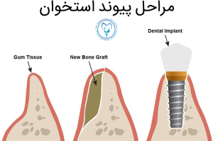 مراحل پیوند استخوان در ایمپلنت دندان