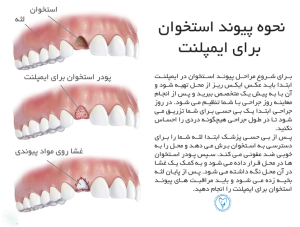 نحوه پیوند استخوان برای ایمپلنت دندان