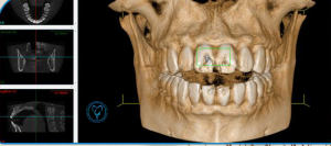 CBCT برای ایمپلنت