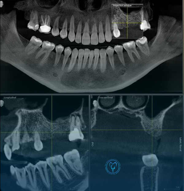 CBCT برای ایمپلنت دندان CBCT برای ایمپلنت دندان