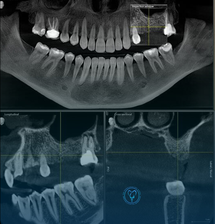 CBCT برای ایمپلنت دندان