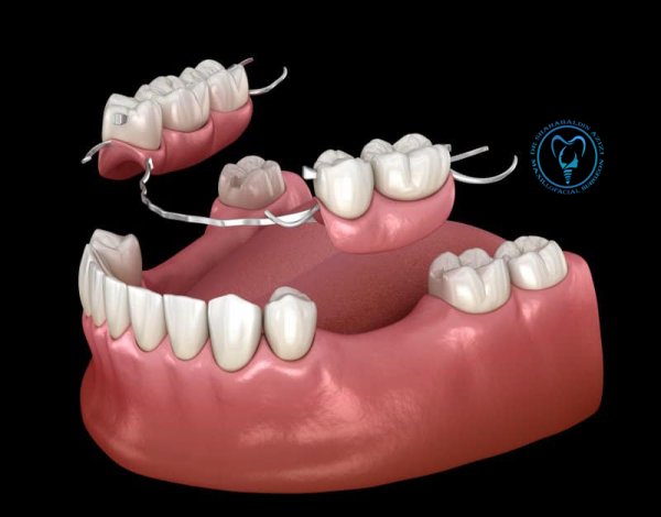 ایمپلنت بهتر است یا پارسیل؟ ایمپلنت بهتر است یا پارسیل؟