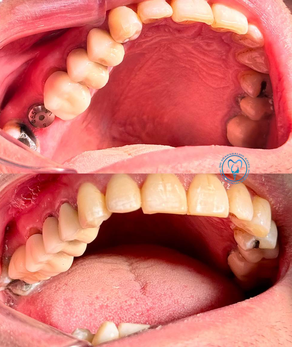 ایمپلنت فرش ساکت