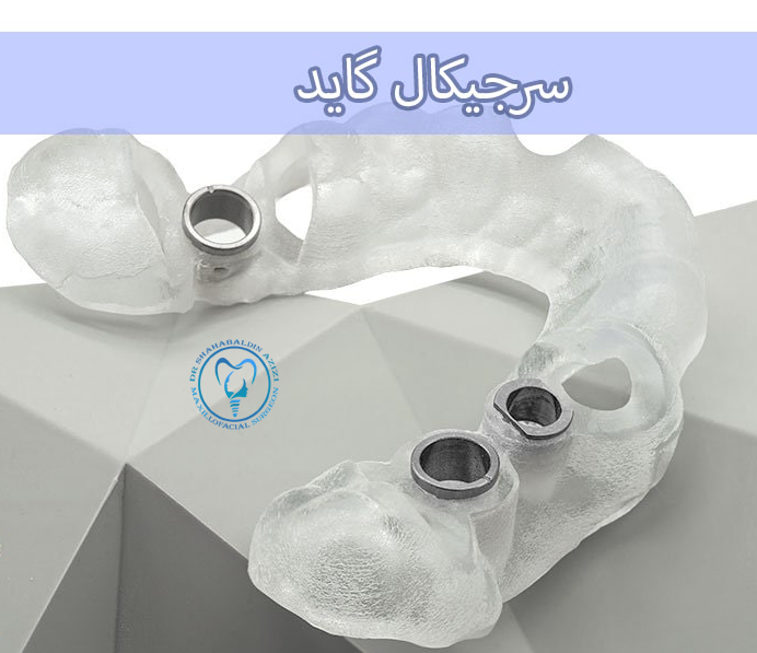 تأثیر سرجیکال گاید بر ایمپلنت دندان