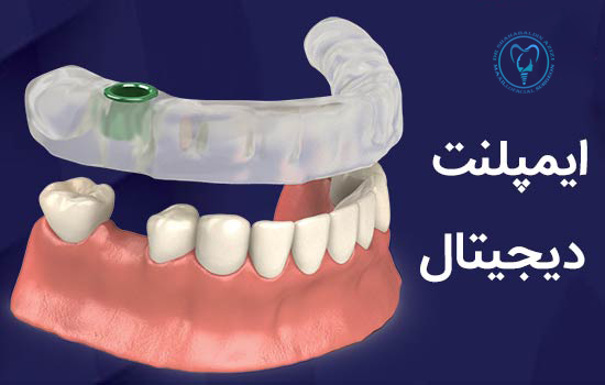 مرکز ایمپلنت دیجیتال