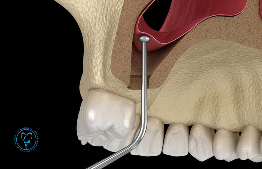 سینوس لیفت open