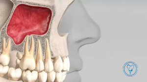 سینوس لیفت باز