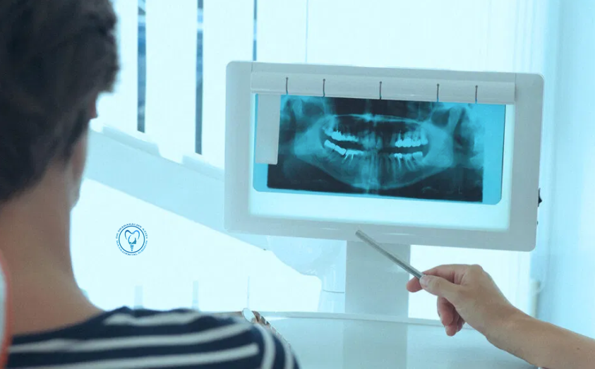 پارستزی بعد از ایمپلنت دندان