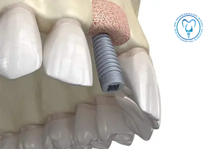 پوکی استخوان برای کاشت ایمپلنت دندان