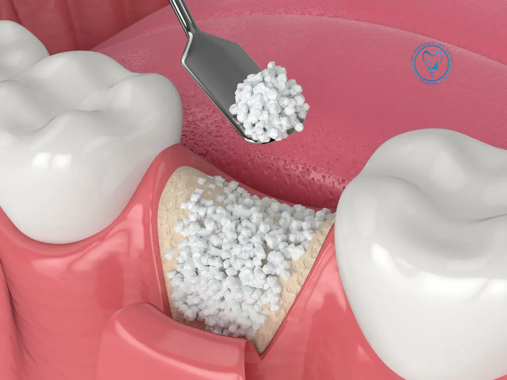 پیوند استخوان GBR