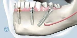 کاشت دوباره ایمپلنت دندان