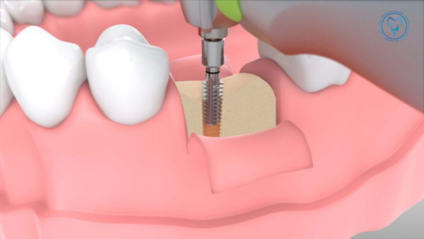 ایمپلنت بدون جراحی ایمپلنت بدون جراحی