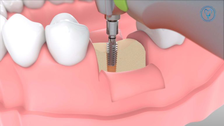 ایمپلنت بدون جراحی