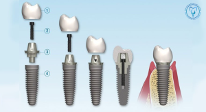 انواع فیکسچر ایمپلنت دندان