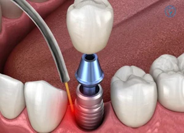 ایمپلنت دندان لیزری چیست؟ ایمپلنت دندان لیزری چیست؟