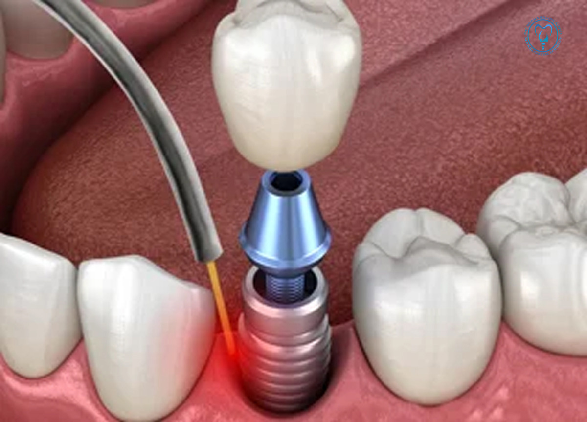 ایمپلنت دندان لیزری چیست؟