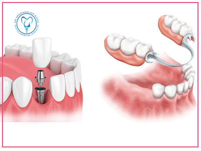 تفاوت ایمپلنت دندان و پروتز دندان
