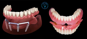 تفاوت ایمپلنت و پروتز دندان