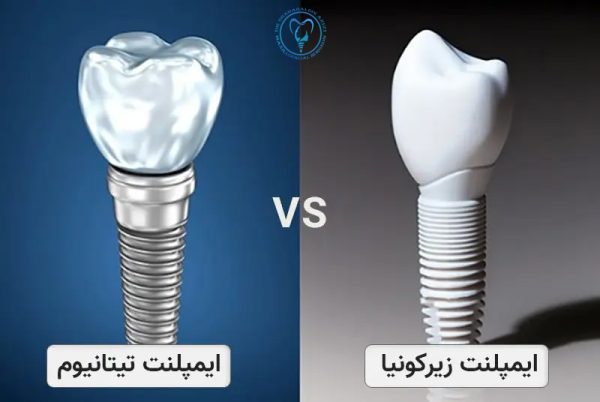 تفاوت ایمپلنت‌های تیتانیومی و زیرکونیومی