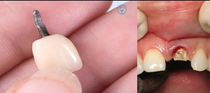 لق شدن ایمپلنت